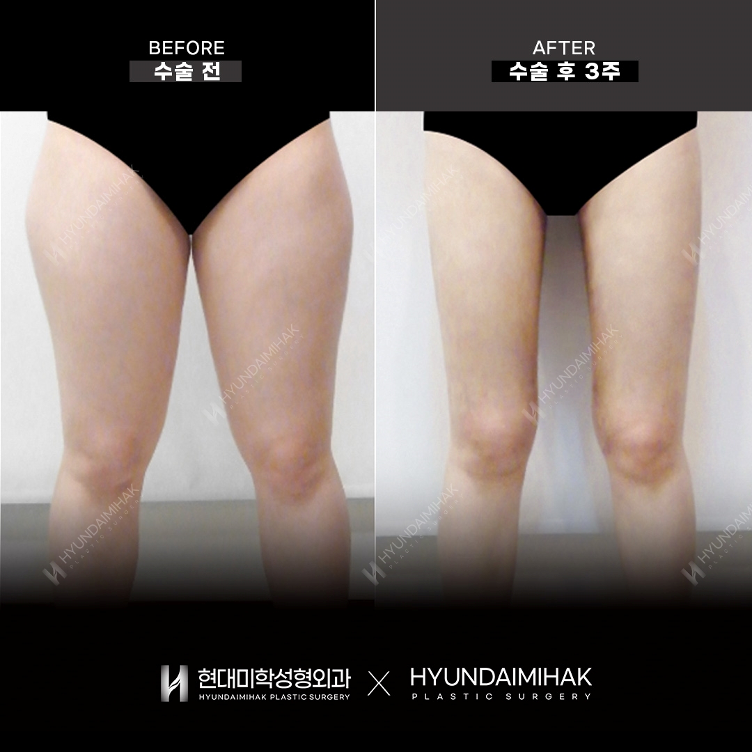 Thigh Liposuction, 3 Weeks