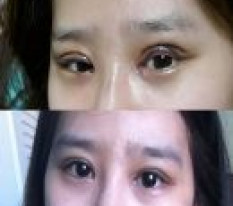 I found the confidence I had lost through eye revision surgery ㅜㅜㅜ!