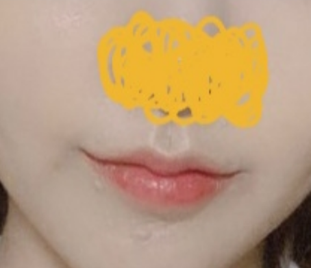 Mouth-corner surgery was a success >_<