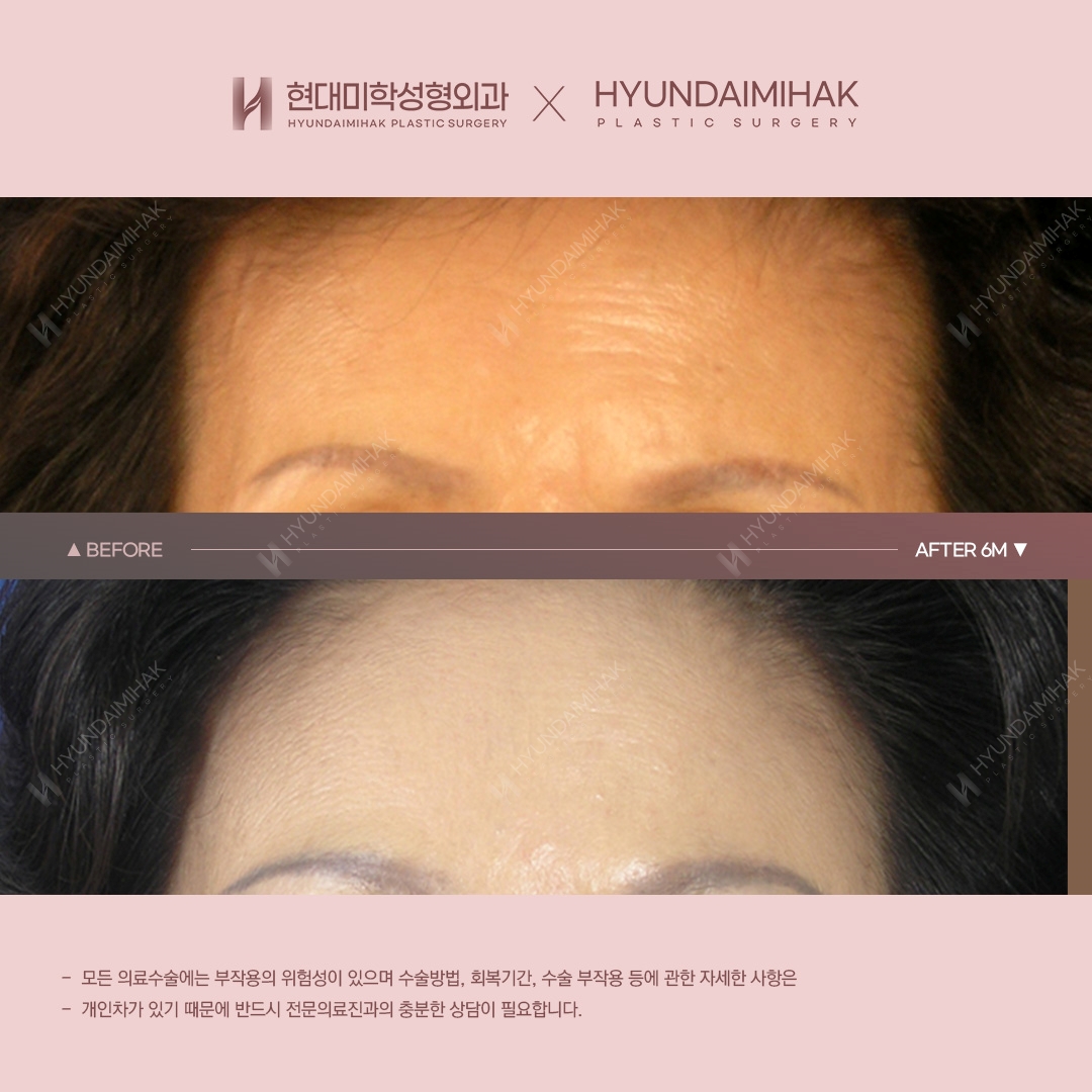 [Anti-Aging Surgery] Forehead Lift, 6 Months Post-Op