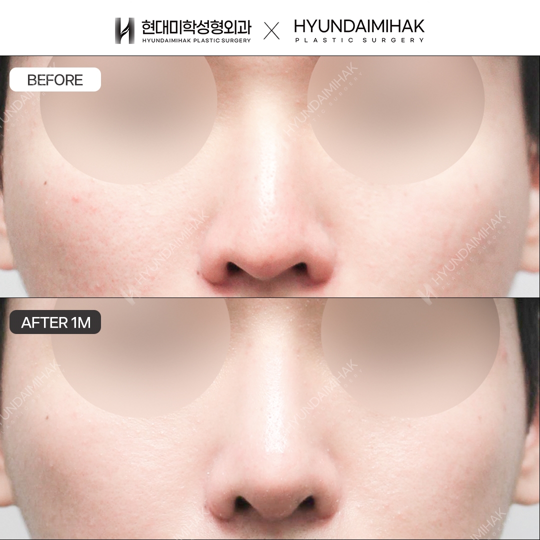[Male rhinoplasty] Nasal bridge + nasal tip, 1 month post-op