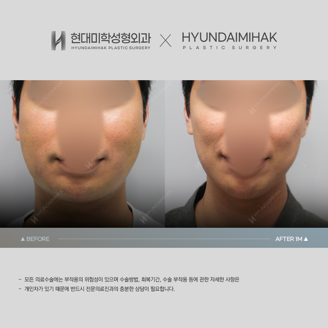 [Anti-Aging Surgery] Thread Lift, 1 Month