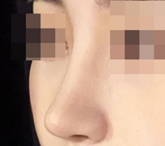I recommend Hyundai Aesthetic Surgery to anyone who wants pretty nose surgery!!!!!