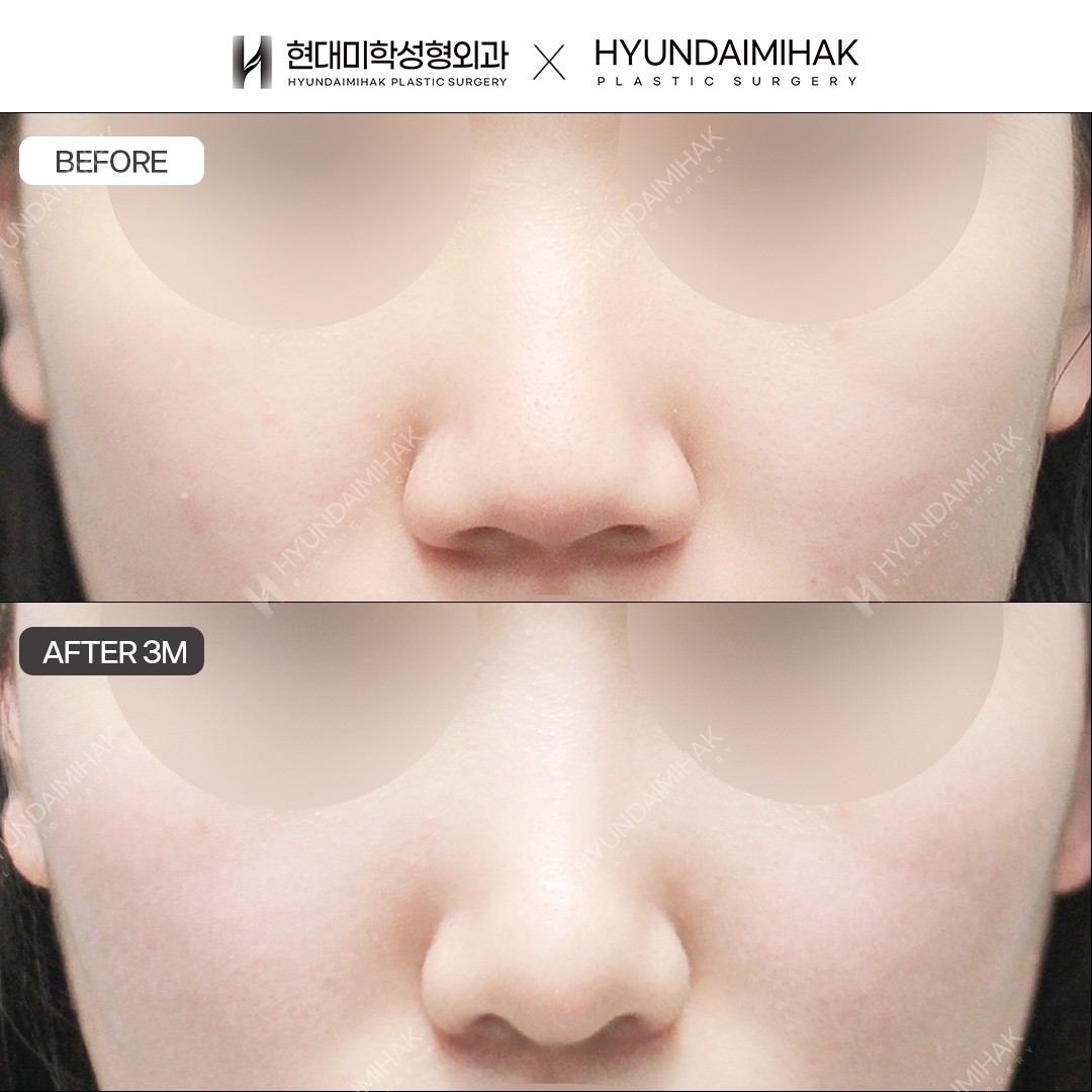 [Bulbous Nose Surgery] Bridge + Tip, 3 Months