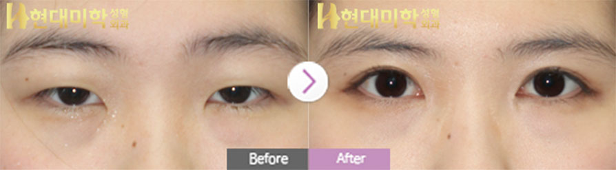 Incisional Method, Ptosis Correction, Epicanthoplasty