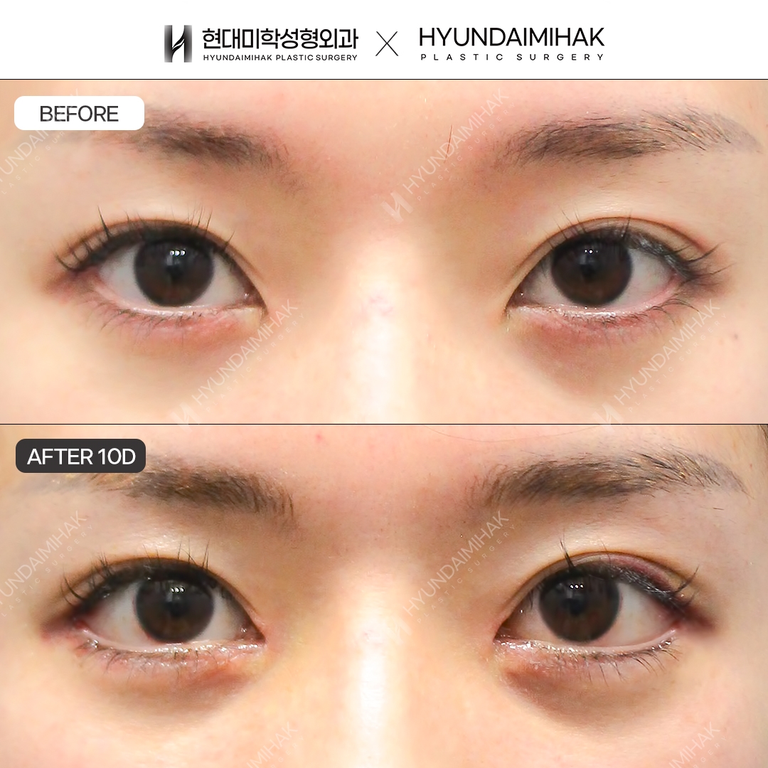 [Canthoplasty] Lateral canthoplasty + lower canthoplasty