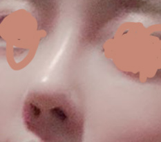 I am really glad I got revision nose surgery at Hyundai Aesthetic Surgery~