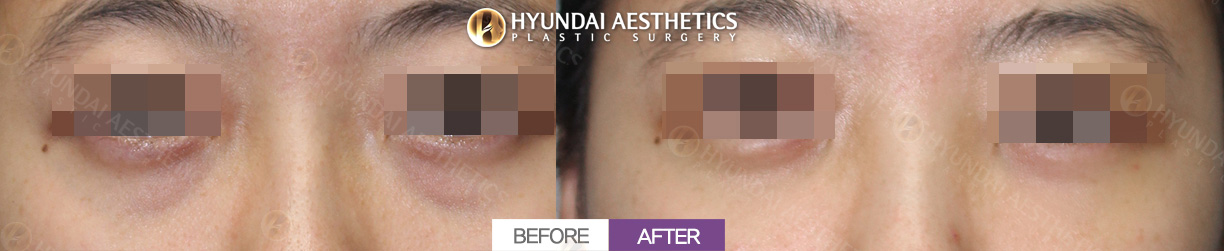 Under-Eye Fat Repositioning, 1 Month