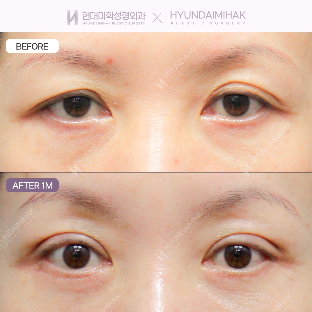 [Asymmetrical Eye Correction] Incisional Double Eyelid + Ptosis Correction + Lower Blepharoplasty