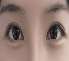 My buried double eyelids came undone, so I had revision incisional double-eyelid surgery with Director Hwang Ho