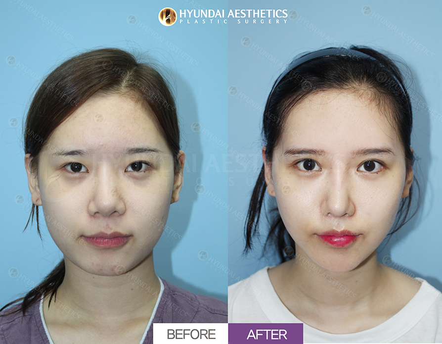 Revision Rhinoplasty + Alar Base Reduction