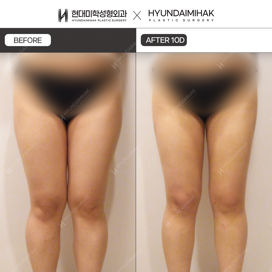 Thigh liposuction, 10 days after surgery