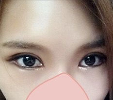 I am embarrassed, but posting a review of my double eyelid surgery and full canthoplasty^^