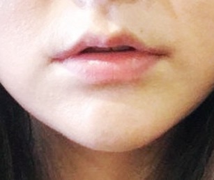 Lip surgery review~3~