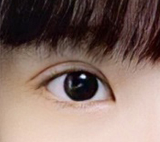 Day 10 after double eyelid revision — looks like it turned out great, so satisfied!