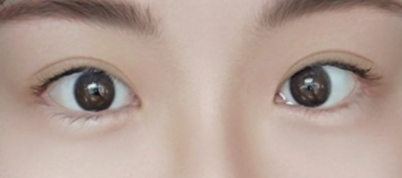 My impression changed after revision eye surgery