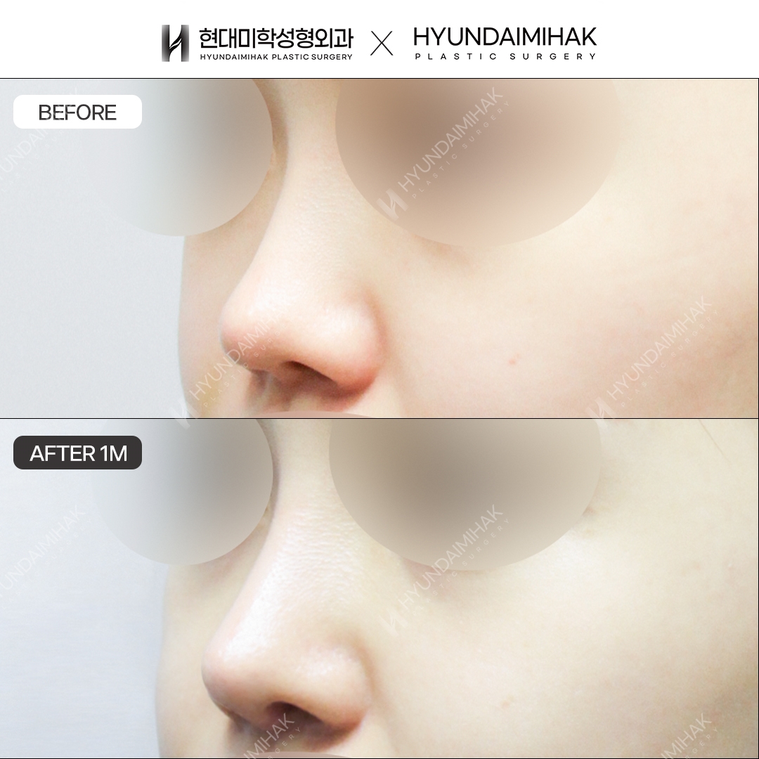[Revision Rhinoplasty] Nasal Bridge + Nasal Tip, 1 Month Post-Op