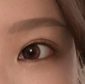 Life is worth living after my eye revision surgery ㅠ