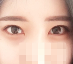 I did lower and back canthoplasty!!!!