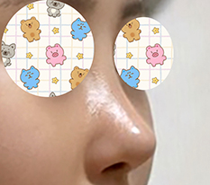 I got my nose bridge done