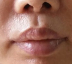 Outer philtrum reduction