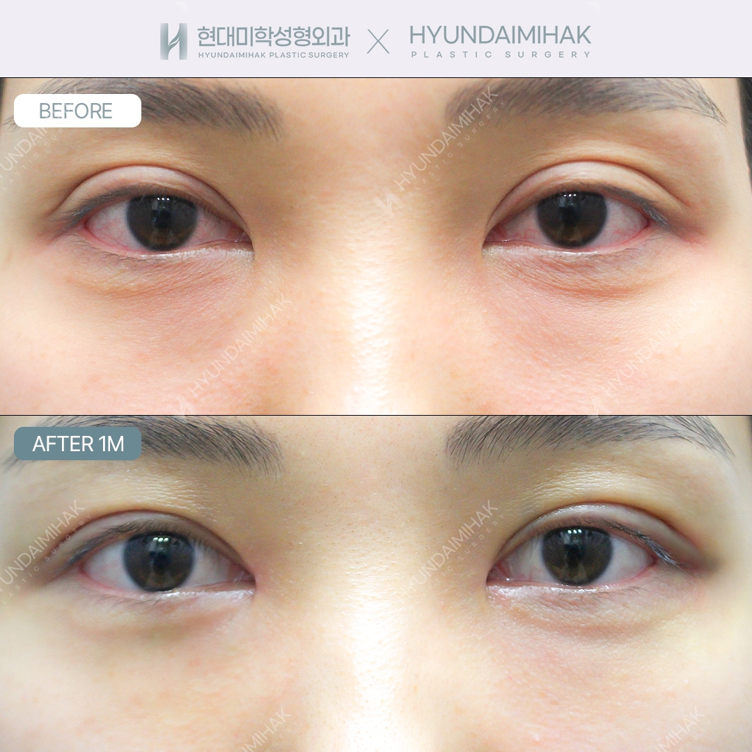 [Eye revision surgery] Lowering the crease line + eye shape correction