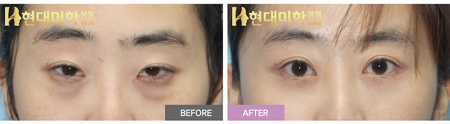 Eye Surgery, Revision Incision Double-Eyelid Surgery, Ptosis Correction, Epicanthoplasty, Lateral Canthoplasty, Lower Canthoplasty, Lower Blepharoplasty
