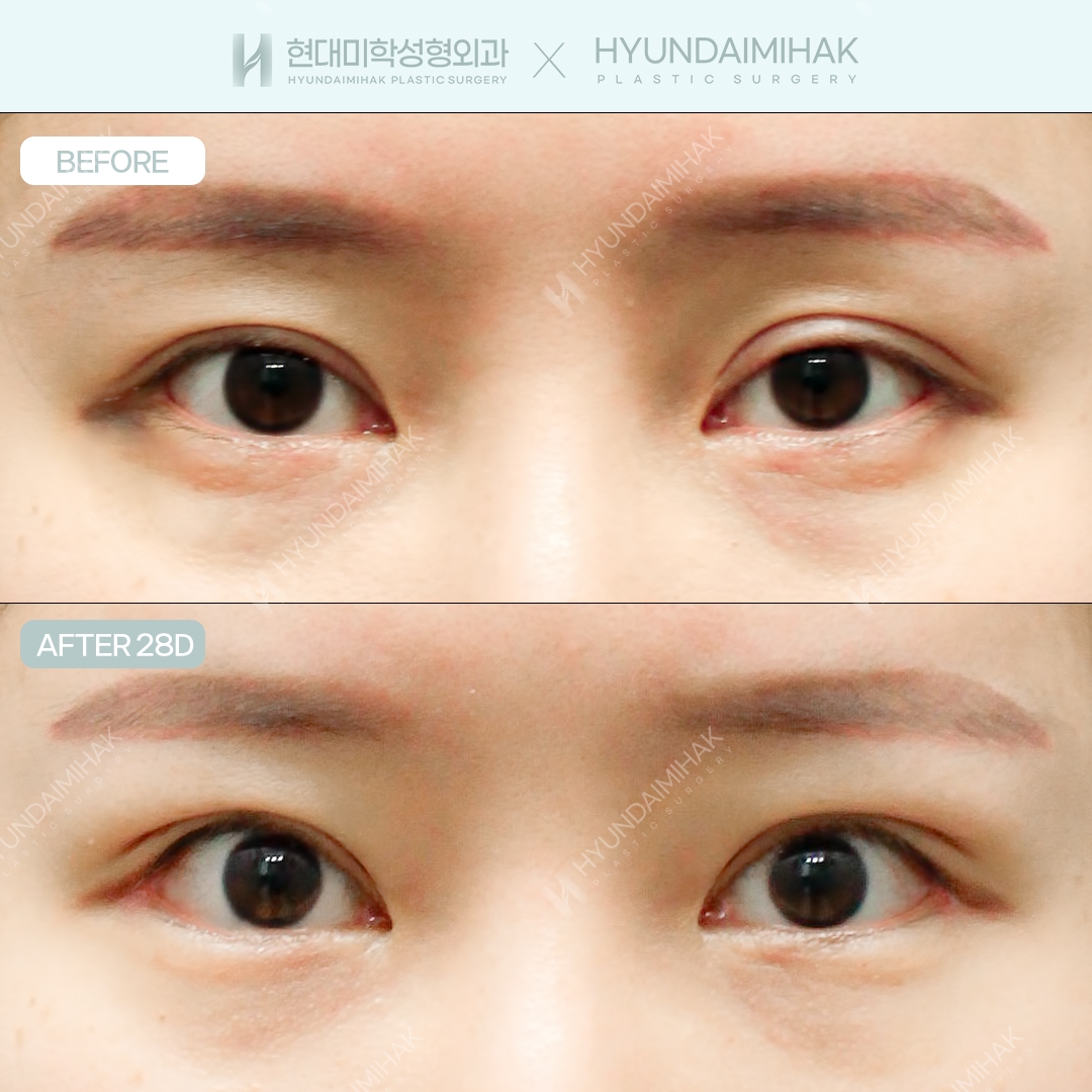 [Revision Eye Surgery] Incisional Ptosis Correction + Dual Canthoplasty
