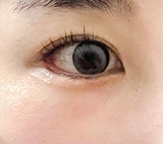 Glamorous dual canthoplasty
