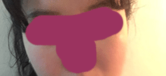 I think my cheekbone reduction turned out well, right??