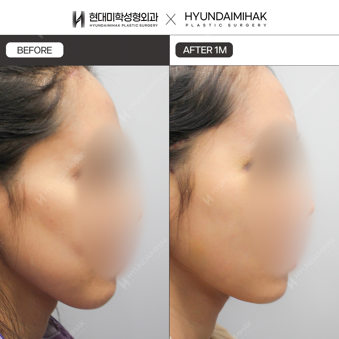 [Anti-Aging Surgery] Thread Lift, 1 Month