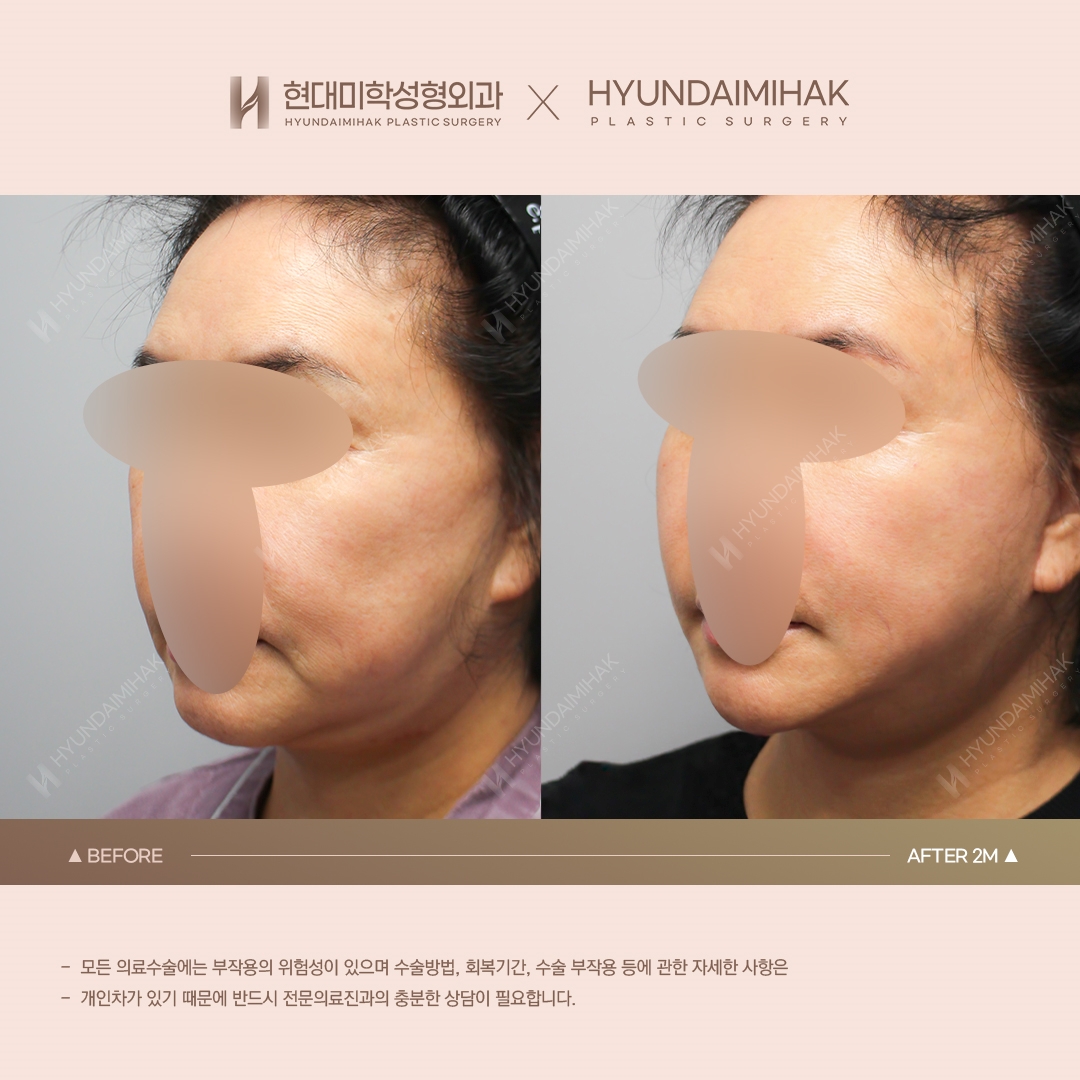[Facial Rejuvenation] Thread Lift, 2 Months Later