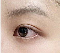 Posting my 2-month double eyelid review ㅎㅎ What do you think??