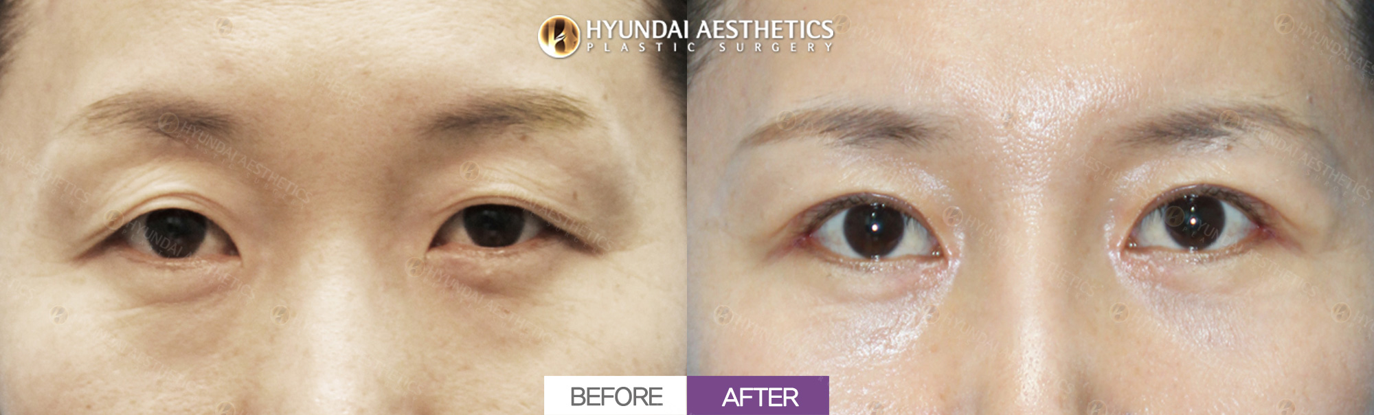 Upper blepharoplasty + ptosis correction, 1 month