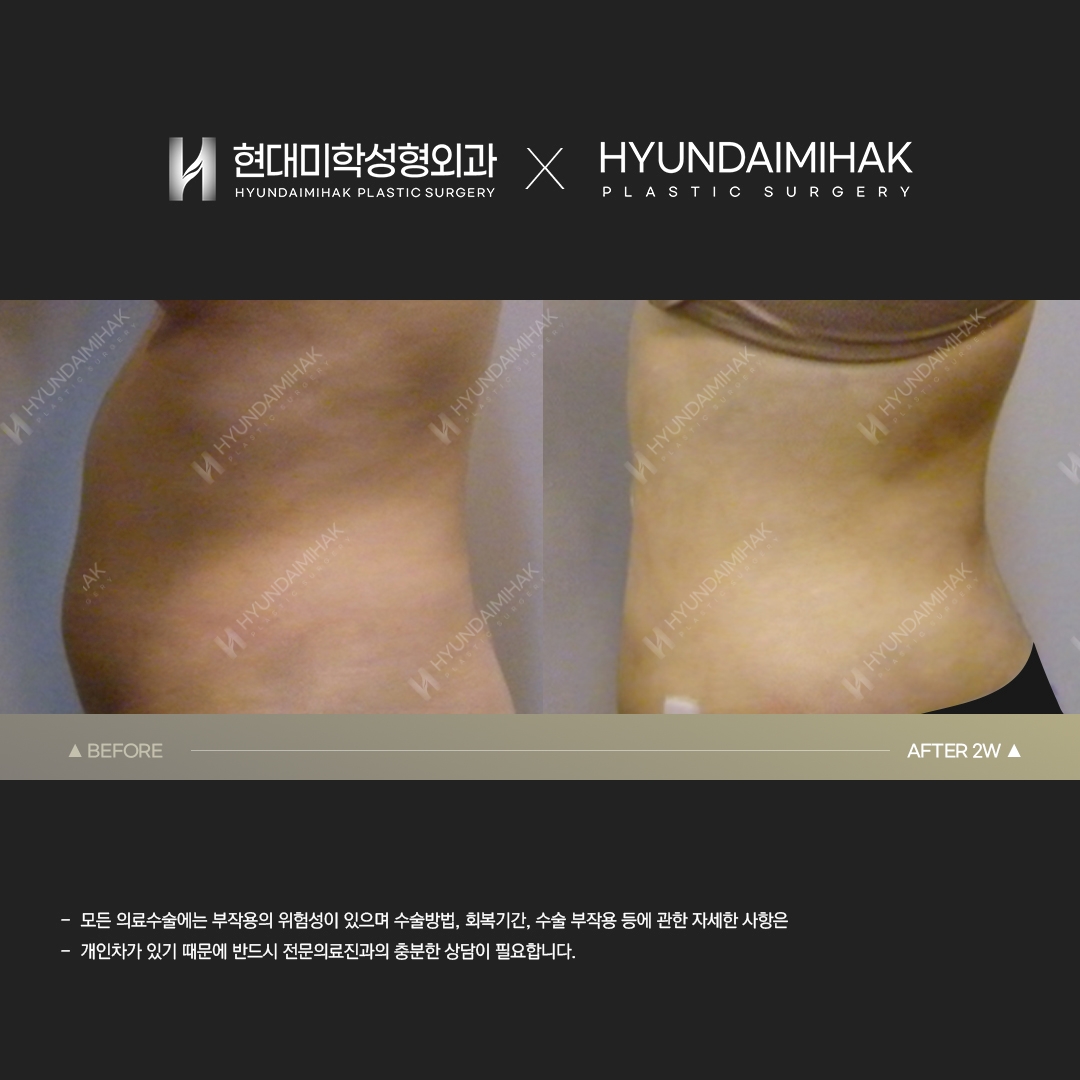 Abdominal Liposuction, Week 2