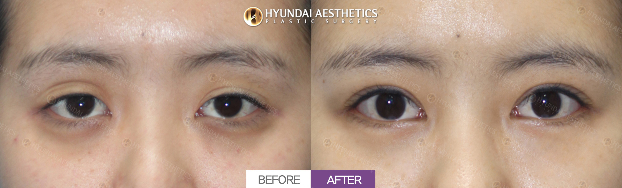 Incisional ptosis correction + epicanthoplasty direction change + double eyelid surgery + lateral canthoplasty, 1 month