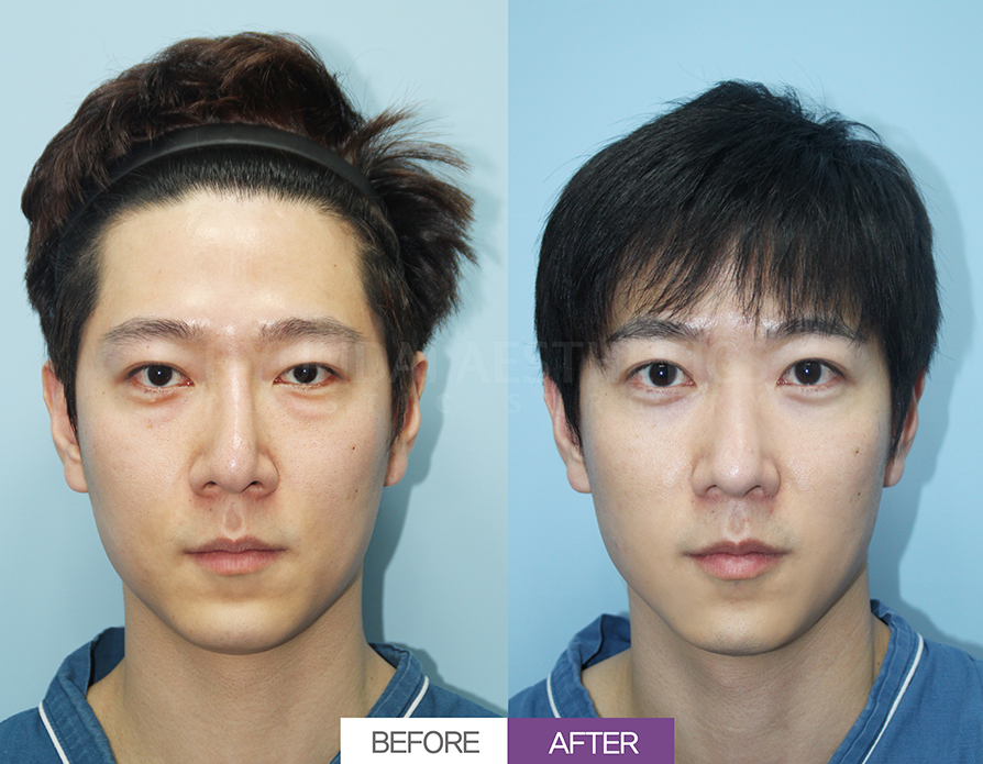 Incisional Double-Eyelid Surgery + Ptosis Correction