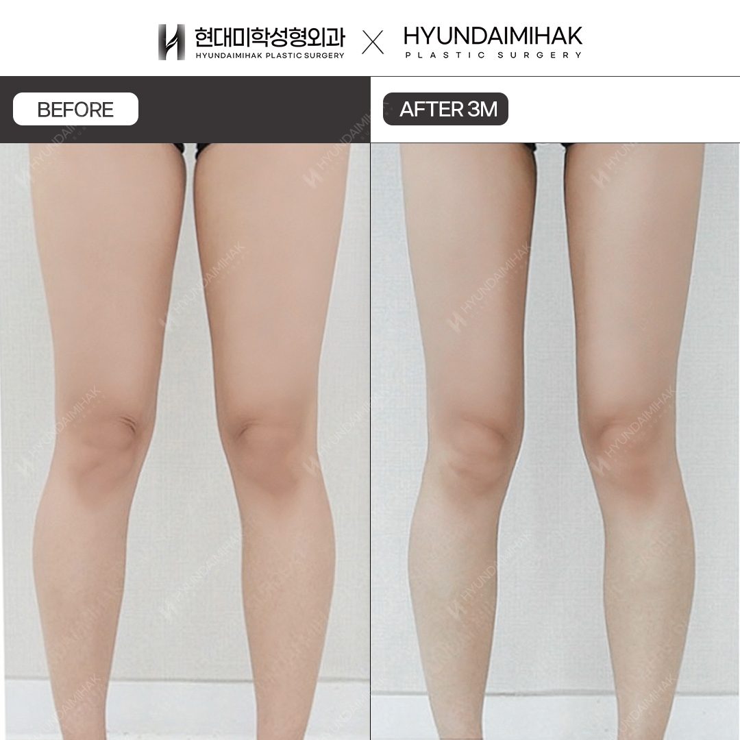 3 months after thigh liposuction