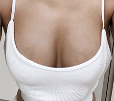 It's already been 6 months since I got breast surgery at Hyundai Aesthetic Surgery!