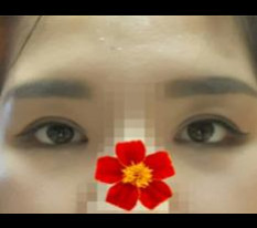 I think I'll never need revision surgery again ㅋ