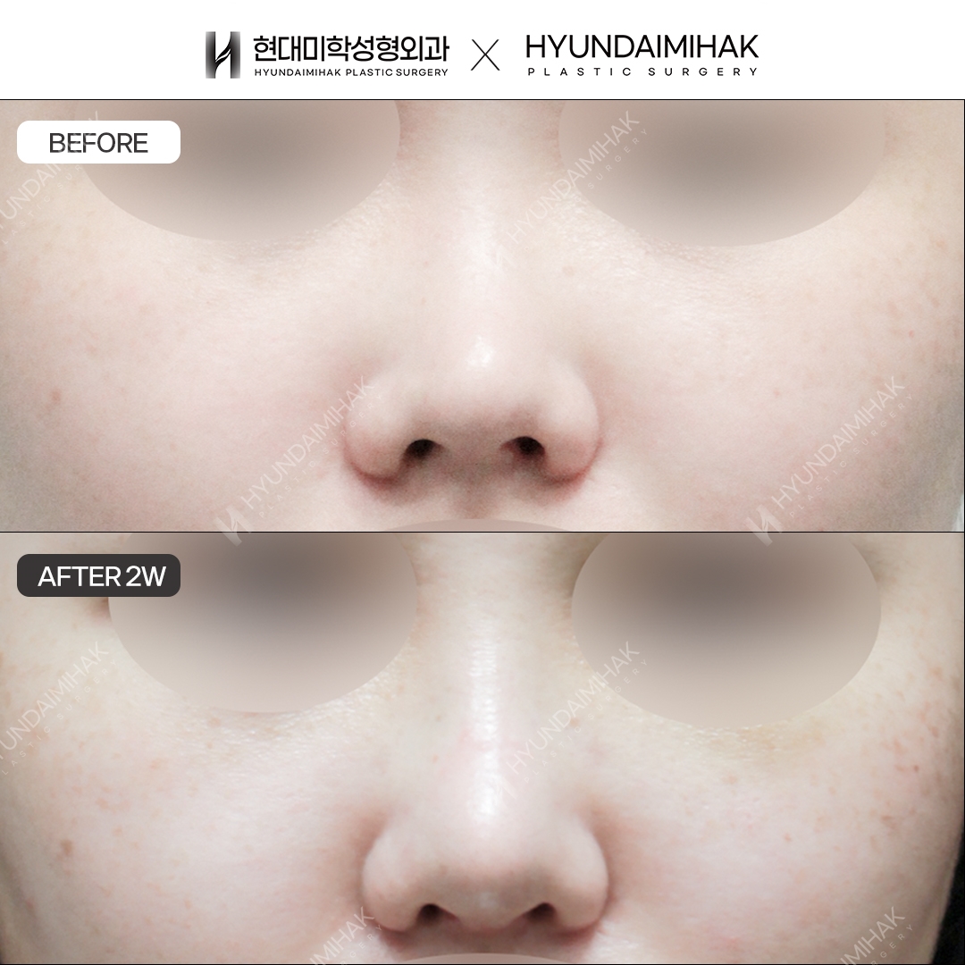 [Short Nose Surgery] Nasal bridge + nasal tip, 2 weeks post-op