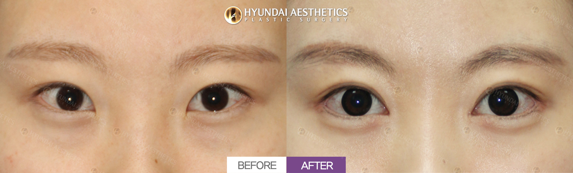 Incisional Ptosis Correction + Inner-Corner Opening + Outer-Corner Opening + Lowering the Outer Corner + Double Eyelids, 1 Month