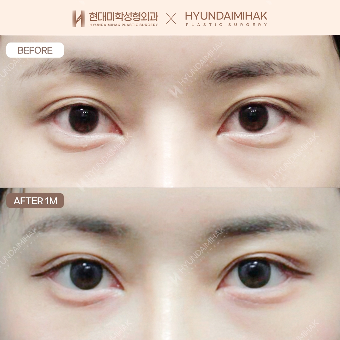 Non-Incisional Ptosis Correction + Dual Canthoplasty