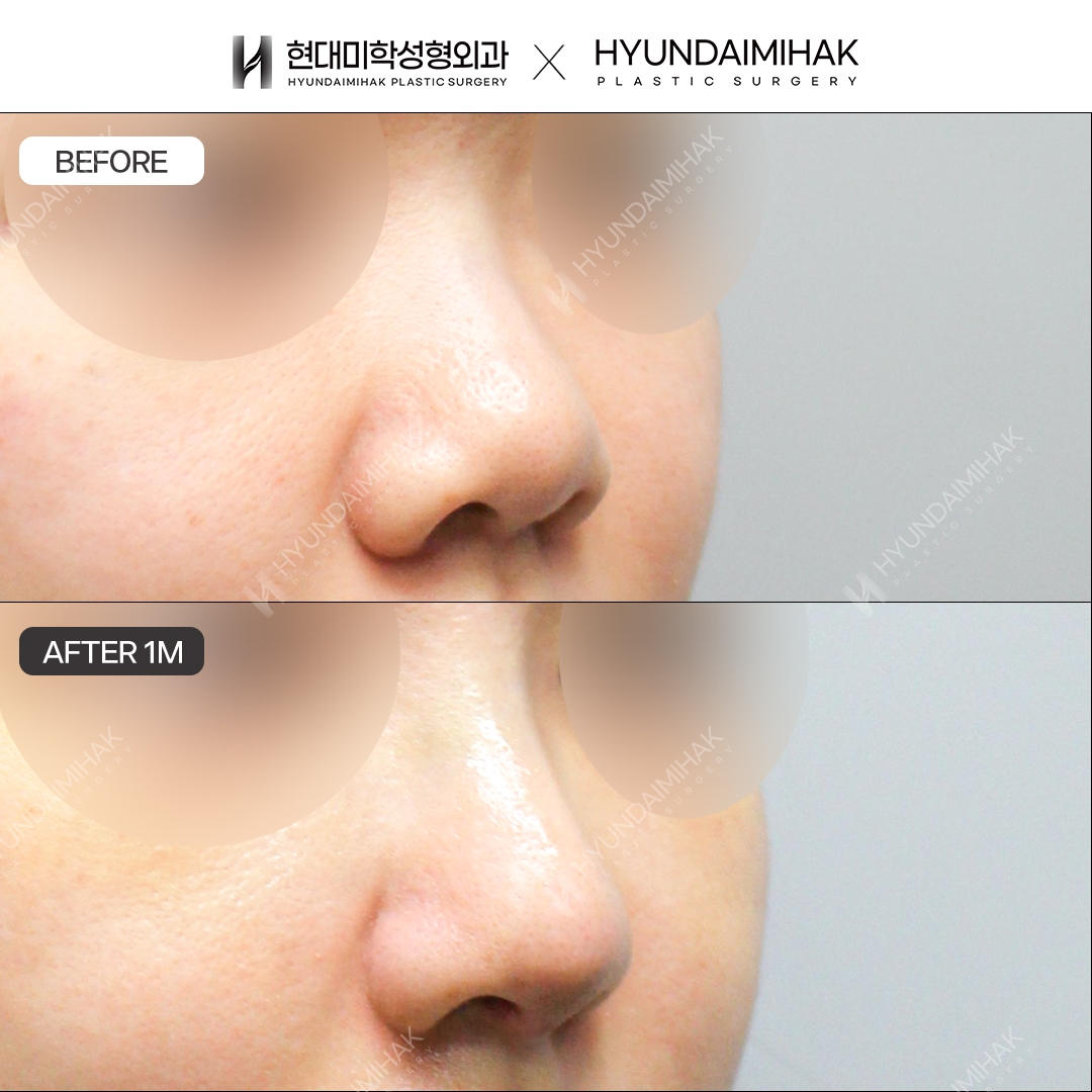 [Bulbous Nose Surgery] Bridge + Tip, 1 Month