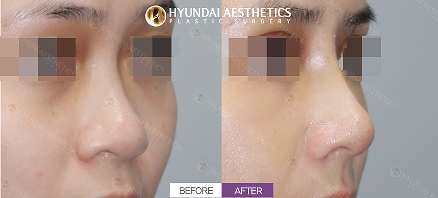 Low-Nose Rhinoplasty