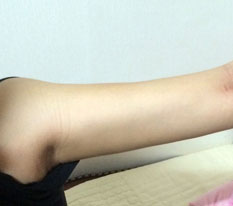 My arm is now half the size it used to be