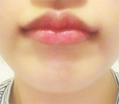 I strongly recommend lip surgery hehe