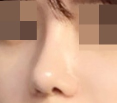 Nose revision surgery review