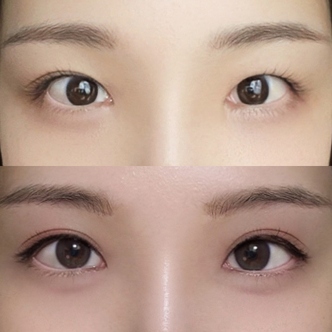 Revision for loosened eyes: double-eyelid revision + ptosis correction + back and lower canthoplasty