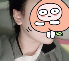 My chin fat disappeared with facial liposuction